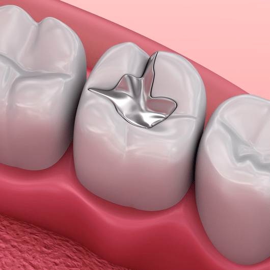 dental implant